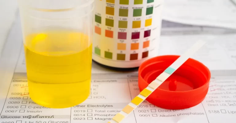 Amostra de urina escura em pote de exame ao lado de tiras reagentes e tabela de cores usadas na análise laboratorial.